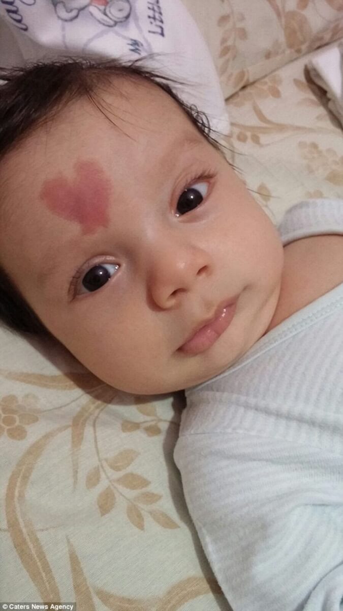 seuamigoguru.com - Bebê nasceu com um coração na testa. E hoje é chamado de "filho do amor"!