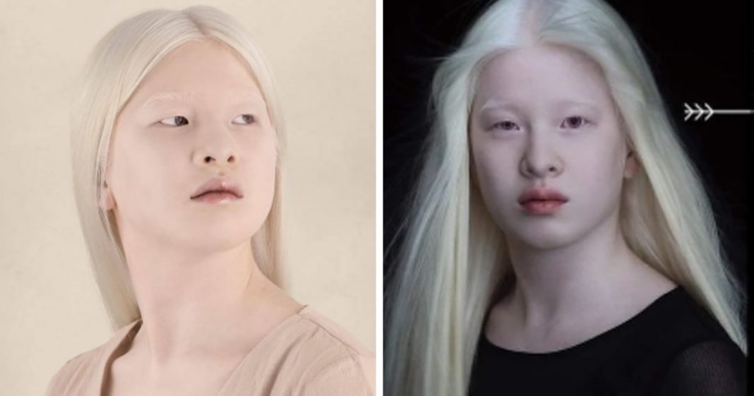 Bebê abandonada por ser albina cresce e se torna modelo da Vogue